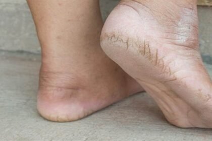 bharatika digital article health crackedheels