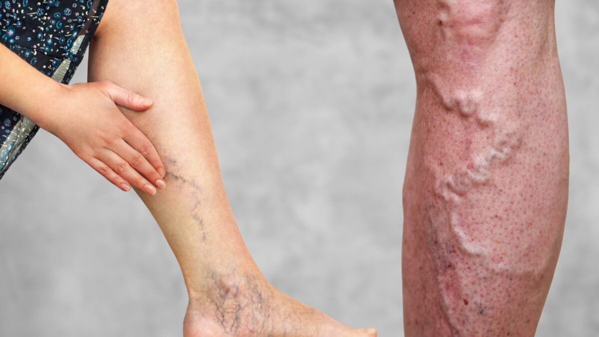 bharatika digital article health varicoseveins