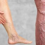 bharatika digital article health varicoseveins