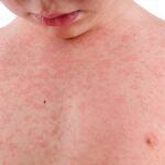 bharatika digital article health measlessymptoms