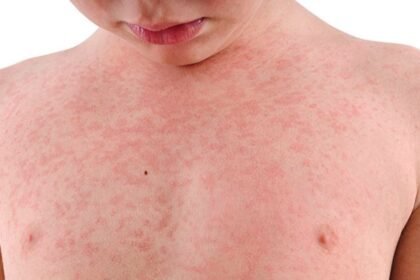 bharatika digital article health measlessymptoms